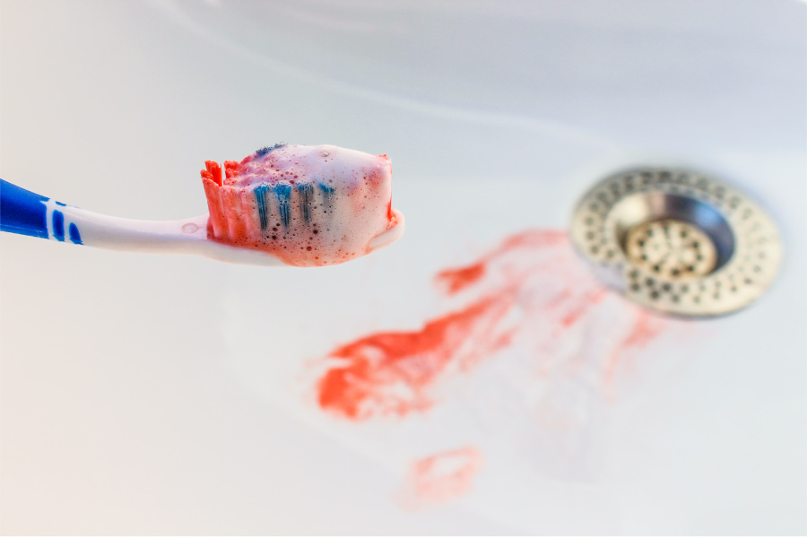 Blood on a toothbrush and in the sink due to bleeding gums from gingivitis