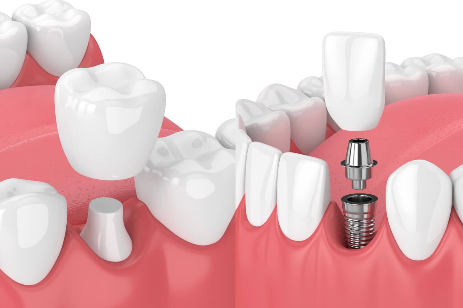 Side-by-side image of a dental crown next to a dental implant