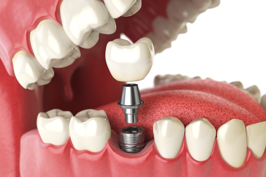 Closeup of a dental implant, a permanent tooth replacement solution in Henderson, NV