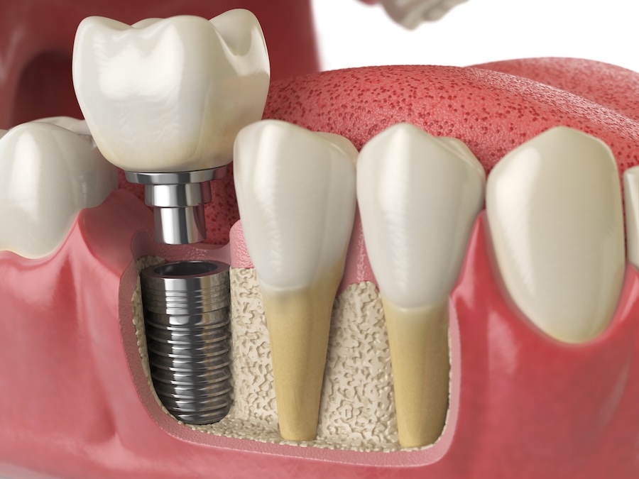 dental implant after osseointegration on tooth #30