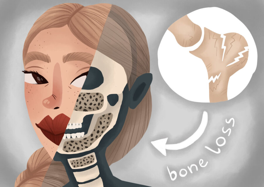 patient experiencing bone loss from missing teeth, gum disease
