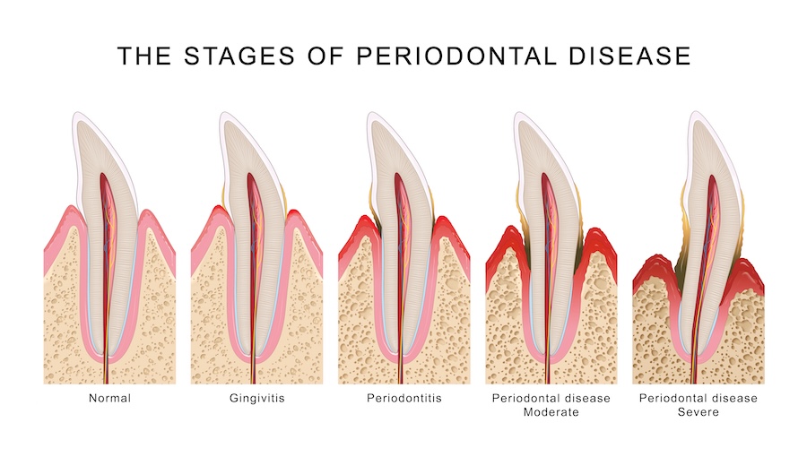 gum pockets, periodontal disease, gum disease, healthy gums