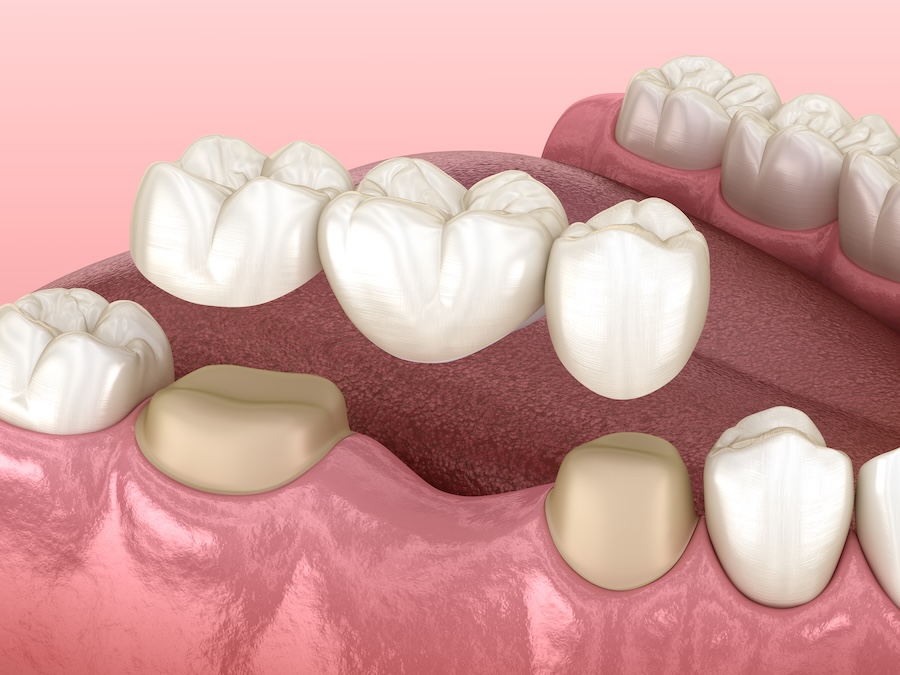 clean a dental bridge
