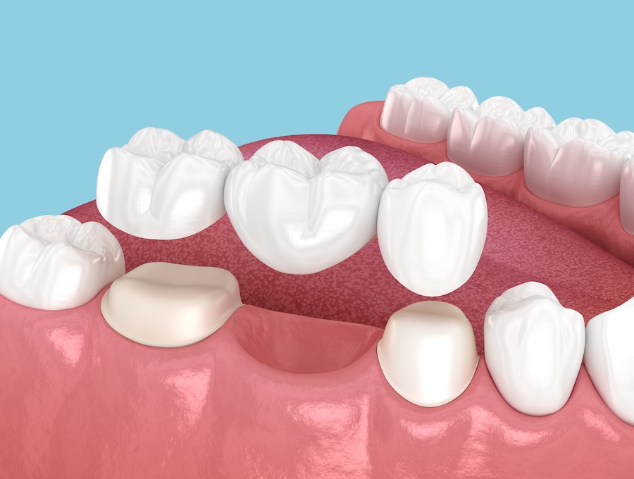 dental bridge, signs a bridge needs to be replaced